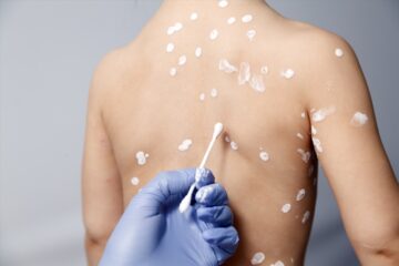 Pox rash on a Caucasian person's back.